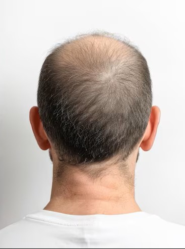 Hair regrowth before