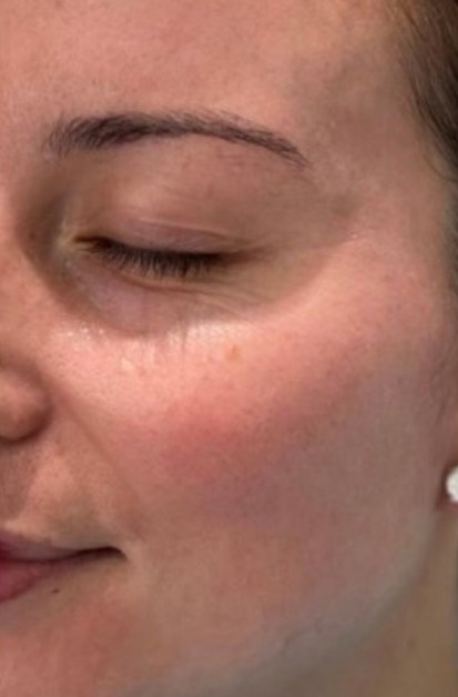 Pigmentation before