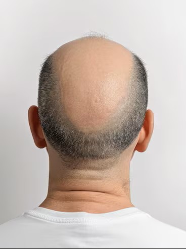 Hair regrowth after