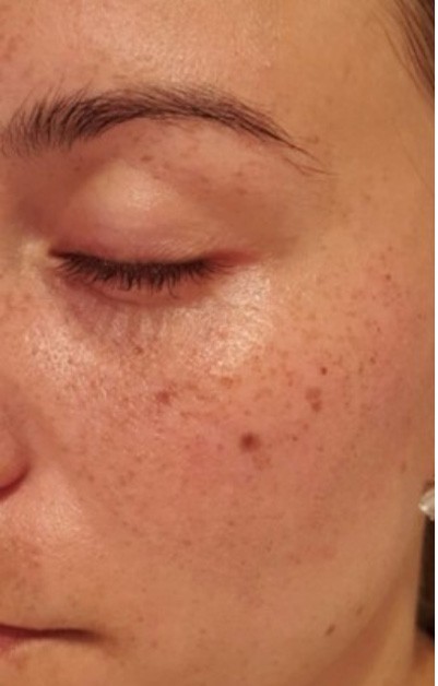 Pigmentation after