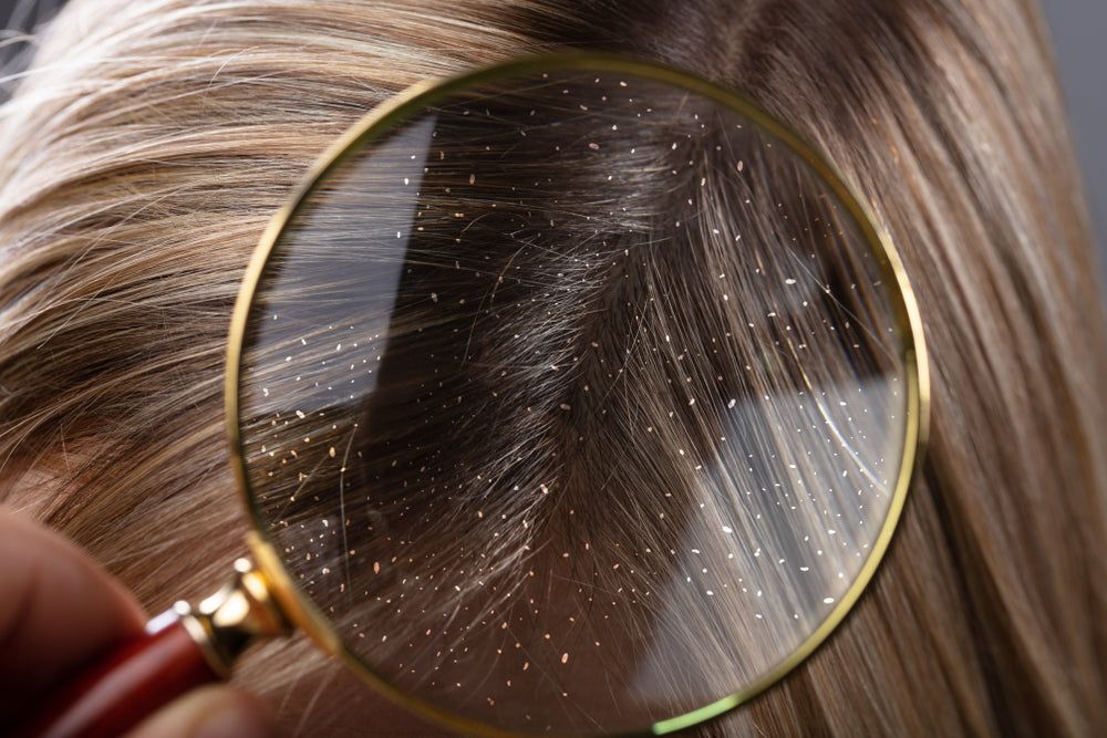 Dandruff and Hair Fall: Are They Connected?
