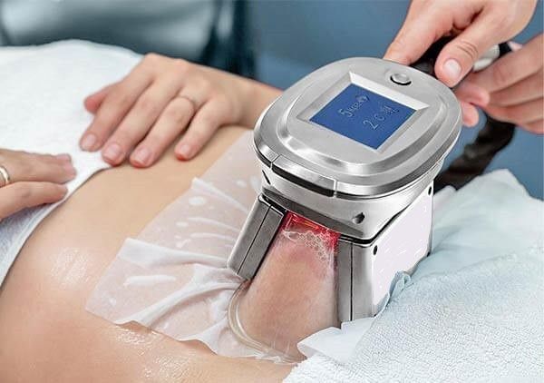 What Is Cryolipolysis and Who Should Consider It?