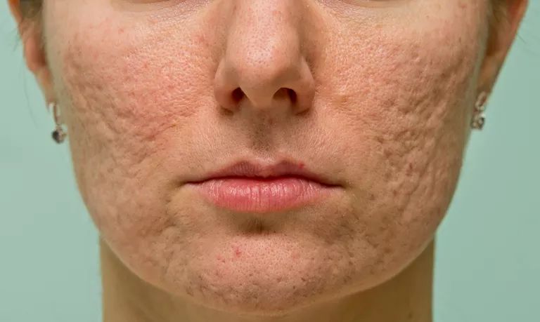 Acne Scars: Why They Form and Which Treatments Help