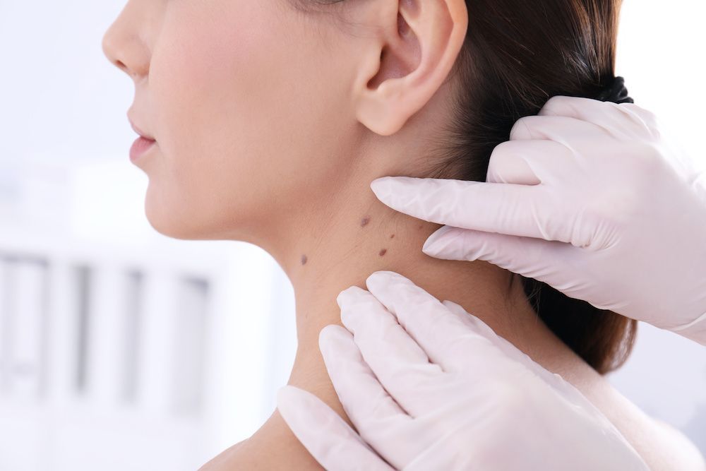 Mole & Wart Removal