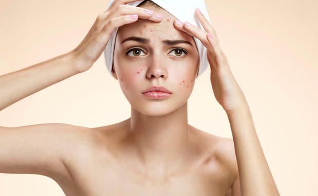 Laser Acne Treatment