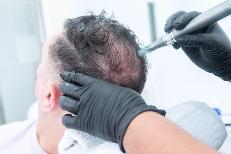 Grade 3 & 4 Baldness: Exosome Hair Regrowth